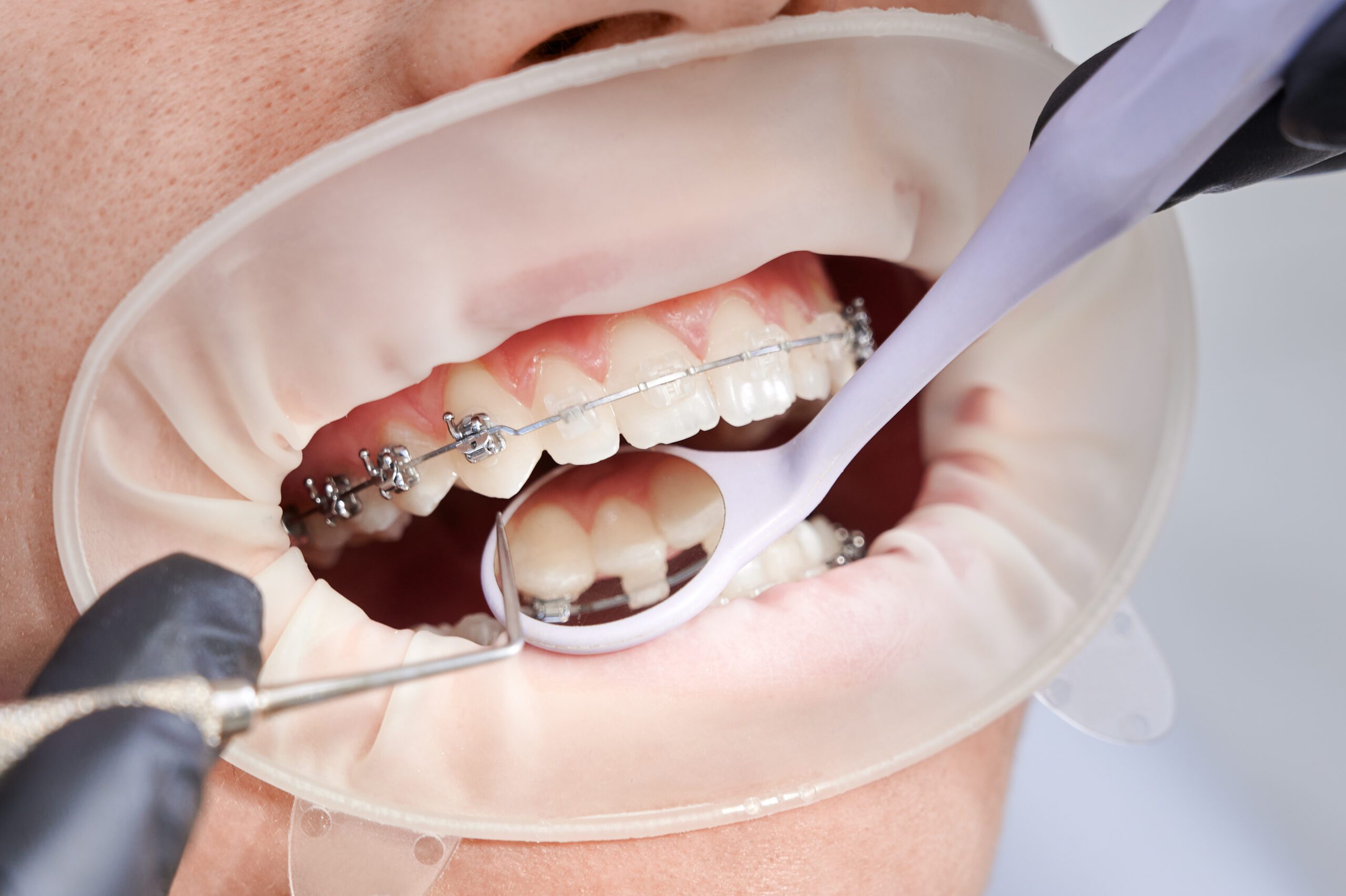 dentist attaching metal braces to patient teeth 1 scaled