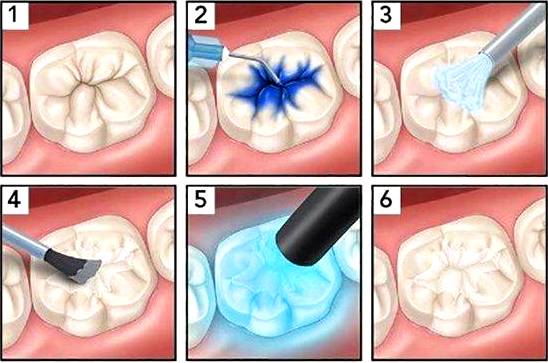 germetizaciya fissur 2