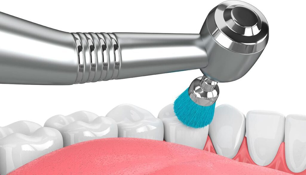 polirovka emali zuba